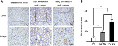 Figure 8 The microvessel density increased in human GC. Immunohistological staining of CD34 was used to determine the microvessel density in paracancerous tissue, well-differentiated GC, and poorly differentiated GC. (A) Representative images. (B) Microvessel density was quantified.