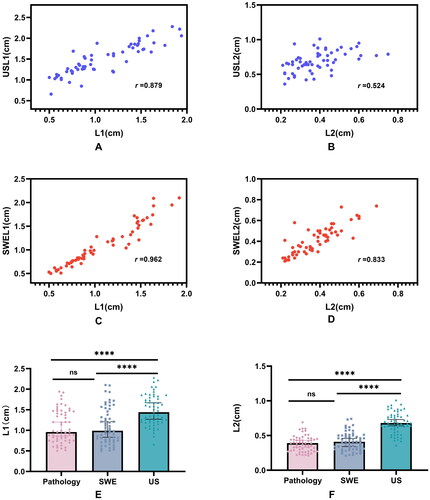 Figure 3. Comparison of ablation area measured by US, SWE and pathology.Note: A, B. Correlation between USL1, USL2 and pathological results, USL1 was positively correlated with L1 (r = 0.879, P < 0.001), while USL2 was positively correlated with L2 (r = 0.524, P < 0.001); C, D. Correlation between SWEL1, SWEL2 and pathological results, SWEL1 was positively correlated with L1 (r = 0.962, P < 0.001), while SWEL2 was positively correlated with L2 (r = 0.833, P < 0.001). E, F. Comparison of ablation area measured by US, SWE, and pathology by Kruskal-Wallis test (****, P < 0.001);