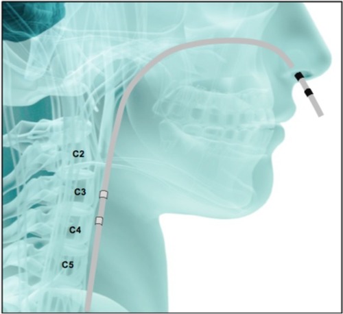 Figure 2 The transit of the electrode for pharyngeal stimulation from the site of introduction to its position in the pharyngeal wall.