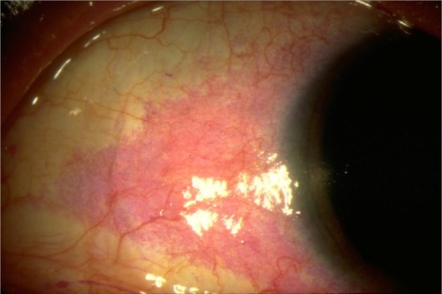 Figure 2 Ocular surface of a dry eye patient following Rose Bengal application.