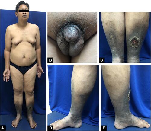 Figure 1 Physical examination showing eunuchoid body proportions, obesity, long extremities, gynecomastia, scanty pubic hairs, small testes (A and B). Shallow ulcer with yellow necrotic tissue on the lower-left leg and atrophie blanche on both lower legs (C). Varicose veins with hyperpigmented indurated skin appear on both lower legs (D and E).