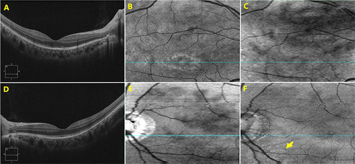 Figure 2 In the right eye, SD-OCT showing disrupted ellipsoid zone, photoreceptor outer segments and interdigitation zone within the fovea (A); the en-face image of the inner segment/outer segment-ellipsoid complex showed hyperreflective spots (B) and Min-IP image exhibited hyperreflective spots (C). In the left eye, no abnormalities were detected either SD-OCT (D) or Min-IP image (E), but hyperreflective spots were observed on the en-face image of the inner segment/outer segment-ellipsoid complex (F, yellow arrow).