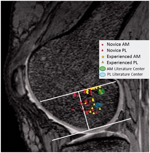 Figure 5. Centers of the anteromedial (AM) and posterolateral (PL) tunnels mapped on the lateral femoral condyle for each knee studied. Tunnel location was determined using the extension of Blumensaat’s line and notch height on sagittal MRI. Novice surgeon computer aided AM and PL tunnels were significantly anterior to tunnels made by experienced surgeons. The range of AM and PL centers from previous anatomic studies are also mapped on the lateral femoral condyle for comparison.