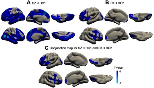 Figure 1 Cortical statistical maps displaying cortical thickness reduction in patients with schizophrenia (SZ) compared with young healthy controls (HC1) (A), as well as in unaffected biological parents of patients (PA) compared with old healthy controls (HC2) (B), and the conjunction map for SZ<HC1 and PA<HC2 (C). Monte Carlo cluster simulation was used for multiple comparison correction with a threshold of P<0.05. The colour bar indicates T values.