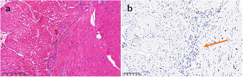 Figure 7 (a and b) The reduced number of intermuscular plexuses are visible in the transverse colon. There were no ganglion cells in some plexuses (HE staining, ×100), the absence of interosseous ganglia seen through SOX10 staining (arrowed).