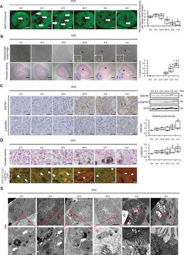 Figure 1. Autophagy declines in the kidneys of mice with calcium oxalate (CaOx)-induced nephrocalcinosis. (A) Numbers of GFP-positive puncta per tubular cross-section (at least 30–50 tubules were counted) in RTCs of GFP-MAP1LC3 transgenic mice (LC3-mice) with glyoxylate (GOX) injection (n = 5/group). Arrows indicate MAP1LC3 puncta. (B) Amount of crystals formed, determined by polarized-light scope images and Pizzolato staining of kidneys extracted from LC3-mice injected with GOX (n = 5/group). (C) Immunostaining and western blotting (SQSTM1/p62; SQSTM1 and phosphorylated SQSTM1; p-SQSTM1) of kidneys from LC3-mice with GOX treatment; relative protein density is indicated (n = 5/group). (D) Pizzolato staining and fluorescence immunostaining of SQSTM1 (red) and counterstaining with DAPI (blue) in MAP1LC3-mice. Arrows and arrowheads indicate MAP1LC3 puncta and SQSTM1 puncta, respectively. (E) Transmission electron microscopy (TEM) images. Asterisks indicate the nucleus, and arrows indicate autolysosomes. M, mitochondria; L, lysosome; C, crystal. Scale bars: 1 mm (B), 20 μm (C, D), 10 μm (A, E; upper), and 0.5 μm (E; lower). Values at 0 h were adjusted to ‘1’ as a reference (C). *P < 0.05 versus 0 h, 6 h, and 12 h; #P < 0.05 versus 24 h; and †P < 0.05 versus 2 d (A, B). *P < 0.05 versus 0 h (C).