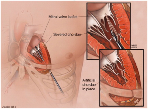 Figure 4. Neochord (Neochord, Minnetonka, MN) chordal repair is a transapical beating heart approach for artificial chordae implantation designed for degenerative mitral valve prolapse.