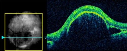 Figure 9 In this Cirrus™ optical coherence tomography image, we can see the sharply demarcated classic edges of the dome on a pigment epithelial detachment.