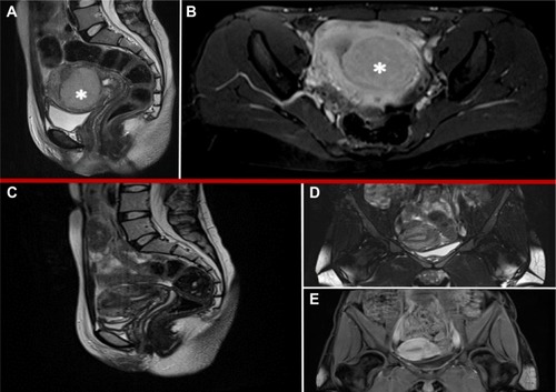 Figure 1 MRI features: preoperative (A, B) and 6 months after surgery (C–E).
