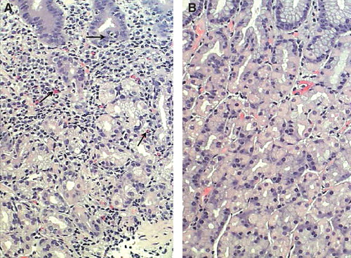 Figure 1. Corpus mucosa with “active” chronic gastritis (A): Inflammation is mononuclear but is accompanied with neutrophils and eosinophils (arrows) which penetrate into the surface epithelium. Normal (B): Normal corpus mucosa without any sign of inflammation is shown as a reference. HE stain × 500.