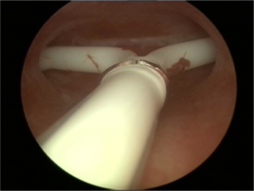 Figure 2 Hysteroscopic picture of Jaydess/Skyla causing pain complaints due to the too long transverse arm in a nulliparous woman.