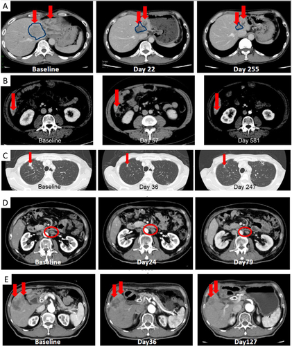 Figure 2 Computed tomography images of (A) Patient 1 at baseline, and showing a partial response at Day 22 and at Day 255 of treatment with brigimadlin monotherapy; (B) Patient 2 at baseline, showing a partial response at Day 57 and 581 of treatment with brigimadlin monotherapy; (C) Patient 7 at baseline, showing partial response at Day 36 and 247 of treatment with brigimadlin + ezabenlimab; (D) Patient 8 at baseline, showing stable disease at Day 24 and a partial response at Day 79 of treatment with brigimadlin + ezabenlimab; (E) Patient 9 at baseline, showing stable disease at Day 36 and a partial response at Day 127 of treatment with brigimadlin + ezabenlimab. Red arrows and red circles indicate lesion location. Blue lines indicate border of lesion.