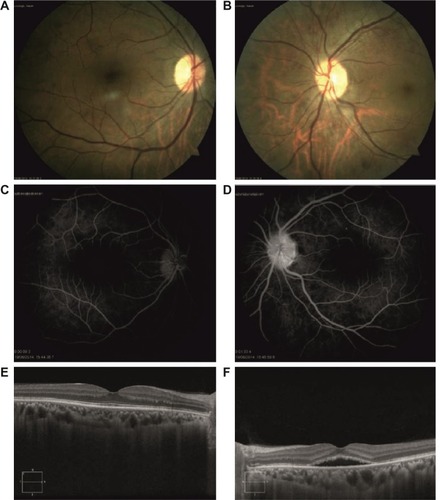 Figure 3 Two months after presentation, BCVA was 20/20 in the right eye and 20/32 in the left eye.