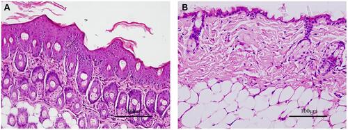 Figure 5 Histopathological examination of skin tissue of the Treatment group (A) prior to treatment and (B) after treatment. Hematoxylin and eosin (HE), scale bar=100μm. After 7 days of treatment with TGP light microscopy of HE stained tissue shows the epidermis and dermis are approximately normal, without corneum thickening, hyperkeratosis, and parakeratosis. (One of the mice in the Treatment group was killed on the 8th day to obtain skin tissue for histopathological examination. No other testing was performed on that mouse.).