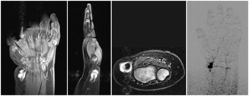 Figure 2. Magnetic resonance angiography (coronal, sagittal, and axial views) revealed a 1.1 × 0.8 × 1.0 cm mass with retrograde arterial filling arising laterally off the distal radial artery from the superficial palmar arch with evidence of thrombosis of the artery proximal to the lesion and intact superficial and deep palmar arches.