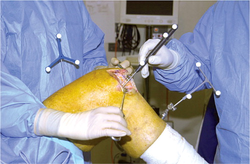 Figure 1. Minimally invasive unicompartmental arthroplasty performed with computer-assisted surgery.