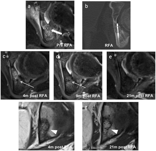 Figure 3. Images of an 8-year-old female with a successfully treated osteoblastoma of the left acetabulum. (a) Axial T1-weighted fat-saturated contrast-enhanced image taken at the time of diagnosis showing strong enhancement of the nidus (thick arrow) with extensive perifocal edema. (b) Axial reformation of the CT scan taken during the RFA procedure showing the needle tip in the nidus. (c–e) Follow-up axial T1-weighted fat-saturated contrast-enhanced images taken at 4, 9 and 21 months post-RFA. (c, d) A target-like appearance (thin arrows) is seen after 4 and 9 months. (e) Disappearance of the peripheral nidus enhancement and perifocal edema after 21 months. (f, g) Follow-up coronal T1-weighted images taken at 4 and 21 months post-RFA showing fatty conversion of the nidus (arrowheads) over this period. RFA: radiofrequency ablation.