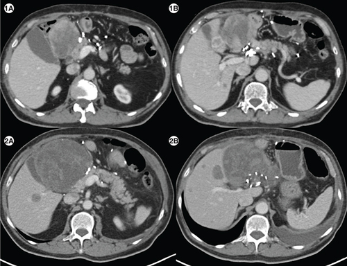 Figure 4. Response to imatinib in case 5.(1A) Axial computed tomography abdomen of patient E showing a heterogenous mass measuring 7.1 × 6.6 cm in the surgical bed in the gastro-hepatic region and a hypodense lesion in segment IVB of liver (1B) measuring1.5 × 1.8 cm. (2A) Axial CT abdomen of first follow-up scan showing a heterogenous mass measuring10.2 × 10.7 cm in the surgical bed in the gastro-hepatic region and a hypodense lesion in segment IVB of the liver measuring 2.9 × 2.8cm (2B), suggestive of disease progression.