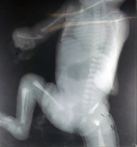 Figure 3 A radiograph of the infant suggestive of absence of right radius bone. Notes: The left upper limb was rotated and hence the absence of radius could not be seen. In addition, low-volume lung in the index case with five intercostal spaces and fracture of shaft of the femur were noted.