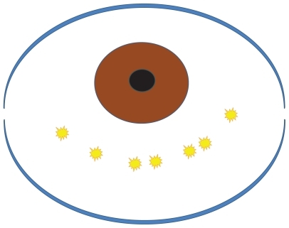 Figure 2 Schema of the coagulation area. The surgical area is in the inferior conjunctiva, 4 mm below the corneal limbus. The inferonasal and inferotemporal areas, which are hidden by the lower eyelid, should also be treated. Five to ten pulsatile coagulations are applied to the inferior conjunctiva (yellow bursts).