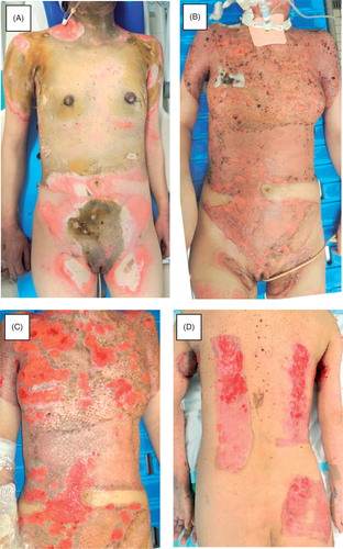 Figure 1. Clinical course of the patient during the first admission. A: Initial clinical appearance. The anterior surface of the trunk exhibits a deep burn. B: Appearance after the first series of debridement and skin grafting. C and D: Multiple ulcers in the grafted skin and donor sites.