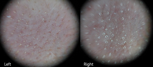 Figure 1. The remaining microcrusts are seen only on the fractional CO2 laser treated side (left) and not on the fractional Er:YAG laser treated side (right) at 1 week follow-up (dermoscopic findings, patient number 11).