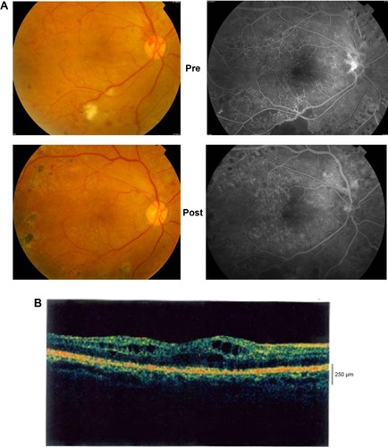 Figure 2 (A) Fluorescein angiographs (left) and photographs (right) of the fundus before and after pars plana vitrectomy and internal membrane peeling, showing improvement in retinal micro- and macro-circulation. (B) Optical coherence tomography image of the macula in bilateral pars plana vitrectomy and internal membrane peeling, showing refractory macular edema.