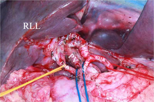 Figure 2 Anatomy of hepatic hilar region.