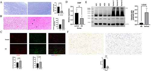 Figure 7 Validation of the expression of von Willebrand factor (VWF) in aortic dissection (AD). (A) Representative images of Masson staining in the aortic tissue from control (left) and AD patient (right). The collagens are stained blue and smooth muscle cells are stained red. In the AD (right), there was significantly elevated deposition of total collagens compared with controls (left). (B) Representative images of haematoxylin and eosin (HE) staining in the aortic tissue from control (left) and AD patient (right). In the control (left), the smooth muscle cells are evenly distributed and neatly arranged. In the AD (right), the disarrangement and the loss of smooth muscle cells are detected as indicated by black arrows. (C) Representative images of immunofluorescent staining of smooth muscle cells in aortic tissue from control and AD patients using specific marker proteins ACTA2 and SM22α. Nuclei (blue) were visualized with DAPI. ACTA2 (red) – actin alpha 2, smooth muscle, and SM22α (green) – smooth muscle protein 22 alpha were labelled with the respective antibodies. (D, E) Decreased VWF expressions in aortic tissues from AD patients were detected by PCR and Western blotting compared to controls. (F) Representative images of VWF immunohistochemistry in control (left) and AD (right) tissue. The staining for VWF was significantly decreased in AD. *p <0.05.