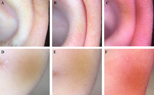 Figure 2 Standard dermoscopic presentations of the skin of the auricular scored as 0 (A), 1 (B), and 2 (C) and of the earlobe scored as 0 (D), 1 (E), and 2 (F).