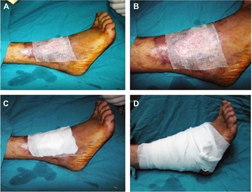 Figure 3 Vaseline dressing is added over amniotic membrane and then covered with dressing.