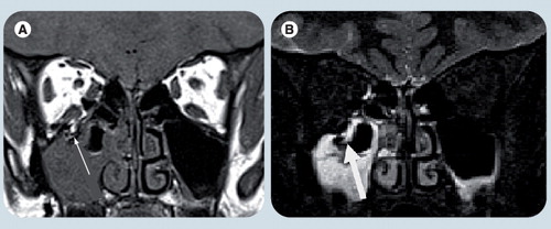 Figure 2. A 9-year-old boy with right orbital floor fracture.(A) Coronal T1-weighted image and (B) T2-weighted image with fat suppression show a right orbital floor fracture (arrow) with prolapsed orbital fat into adjacent right maxillary sinus.Reprinted with permission from Citation[13].