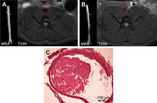 Figure 6 MRA, magnetic resonance imaging T2WI axial images, and pathologic H&E staining of the abdominal aorta.Notes: (A) Before induction of the thrombosis model, (B) post-induction, and (C) H&E staining of a section of the model. MRA revealed vessel lumen narrowing after the FeCl3-induced model was successfully constructed, and the signal in the abdominal aorta changed from low to high on the T2WI axial image. H&E staining confirmed that the mural thrombus was mixed. The magnification is 100×.Abbreviations: H&E, hematoxylin and eosin; MRA, magnetic resonance angiography; T2WI, T2-weighted imaging.