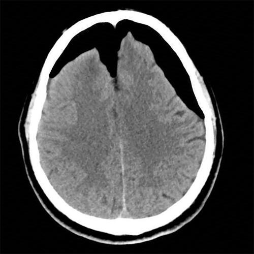 Figure 5 Computed tomography revealing a large area of pneumocephalus in the bilateral anterior cranial fossa. The frontal retention of air caused widening of the interhemispheric fissure, leading to a peaked appearance of the frontal poles, commonly referred to as “Mount Fuji sign”.