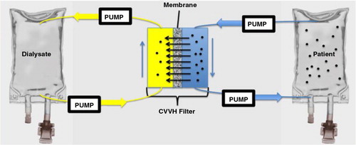 Fig. 4.  Schema depicting CVVH circuit and model patient. A 300 mL IV bag of 0.9 NS served as the model patient and was spiked with EMPs. The circuit contained 170 mL 0.9 NS and ran counter-current against 1 L of 0.9 NS dialysate. After mixing, 0.5 mL aliquots were drawn from the “patient” for analysis as dialysis was completed via the filter.