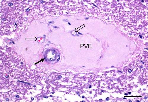 Figure 6. Perivascular proteinaceous edema (PVE) in the cerebellar white matter of a sheep experimentally infected with C. perfringens type D. This lesion is a consequence of the action of epsilon toxin on the vascular endothelial cells, which increases vascular permeability allowing albumin and water to leave the vascular lumen. An arteriole (solid arrow) and two venules (hollow arrows) are indicated. Scale bar = 50 μm. Hematoxylin and eosin