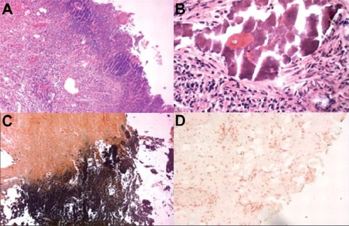 Figure 2 Bladder wall histology of C. urealyticum.Notes: (A) Hematoxylin and eosin staining of bladder biopsies before treatment, showing necrotic tissue and inflammatory infiltration 100× and focal evidence of calcified encrustations on the wall, 400× (B). Von Kossa staining showing calcium deposition at the surface level, 100× (C); Von Kossa staining negative for calcium deposition, 100× (D) after treatment. Reproduced from Del Prete D, Polverino B, Ceol M, et al. Encrusted cystitis by Corynebacterium urealyticum: A Case Report With Novel Insights Into Bladder Lesions. Nephrol Dial Transplant. 2008;23(8):2685–2687, by permission of Oxford University Press.Citation36