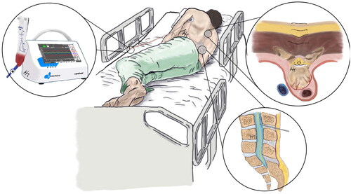 Figure 1. Illustration of the instituted wound repair & CSF diversion protocol. A mid-thoracic wound, closed in layers is demonstrated. Inferiorly, a lumbar drain is in-situ, and is connected to LiquoGuard7® tubing which has an in-line sensor placed at the axilla (approximating the level of the wound in the axial plane). Distal to the sensor, the tubing connects to a portable LiquoGuard7®, by the patient’s bedside.