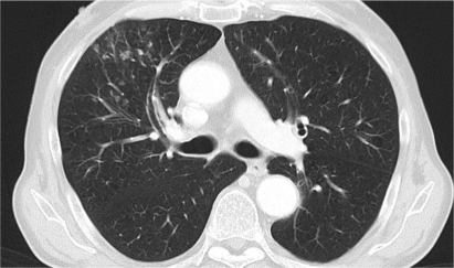 Figure 1 Right-sided, ventral pneumonitis with temsirolimus treatment resembling new metastastic lesions. After 10 days of antibiotic treatment the lesions faded away completely.