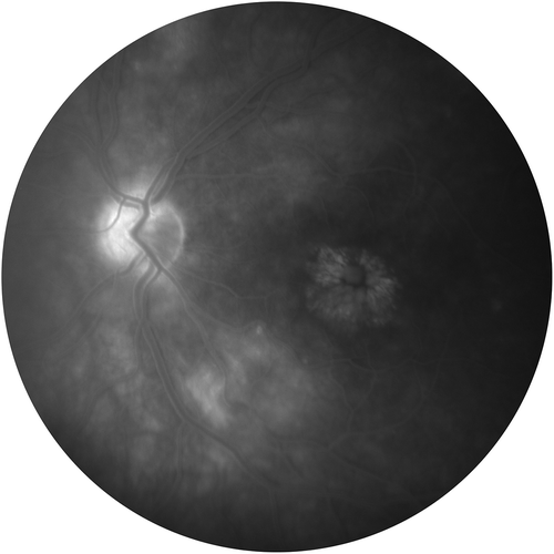 Figure 1a. Fluorescein angiogram of a patient with macular edema from posterior uveitis.