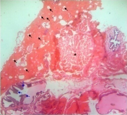 Figure 2. Photomicrograph of prostate tissue section of a rat from group 2 (BPH control; BPH-induced and untreated rats) showing (1) Slight disruption of architectural appearances: There is loss of intracellular papillary infoldings (blue arrow) and are haphazardly distributed with abnormal projection. There were numerous cribriform patterns (black arrow) in keeping for possible adenoma and there is presence of neutrophil infilterates in keeping with possible acute inflammation. H&E. mag. 400X.