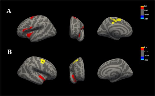 Figure 3. Distribution maps of group differences in the annual rate of change in cortical thickness. (A): The red and yellow regions represent slower rates of cortical thinning of the left hemisphere over time in the SDNP group than in the HC group; (B): The red and yellow regions represent slower rates of cortical thinning of the right hemisphere over time in the SDNP group than in the HC group. The color scale is represented as −log P. Detailed statistical results and numerical values are provided in Tables 4 and 5. SDNP: Shidu parents without any psychiatric disorders; HC: healthy controls.