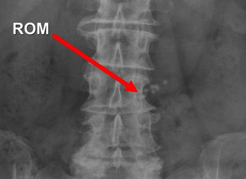 Figure 5 Abdominal radiograph taken after four hours in a patient undergoing ROM testing. As indicated by the red arrow, ROM can be hard to distinguish from the underlying spine, as they have almost identical X-ray opacity.Abbreviation: ROM, [gastric emptying of] radiopaque markers.