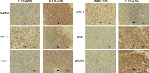 Figure 8. Differences in protein expression of the six ferroptosis-related genes in a DLBCL tumor tissue using immunohistochemistry.