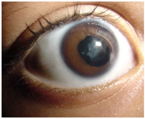 Figure 1 Case 3: unilateral leukocoria secondary to anterior chamber hyphema caused by juvenile xanthogranuloma.