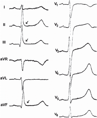 Figure 10. ECG manifestation of inferior early repolarization. Slurred early repolarization pattern in the inferior leads, i.e. deflection from the descending part of the R wave with a smooth transition to ST segment.