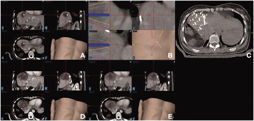 Figure 3. Stereotactic navigation systems on a patient with colorectal liver metastasis (CLM) undergoing liver ablation. (A) Posthepatectomy recurrent CLM measuring 5 cm in diameter (*); (B) Planning of 13 percutaneous guide needles trajectories, represented by different lines; (C) CT evaluation of guide needles placement (*); (D) Postablation CT for treatment verification. (E) Fusion of pre- and post-ablation CT for verification of ablation margin, showing complete tumor coverage with ablation with sufficient ablation margin.