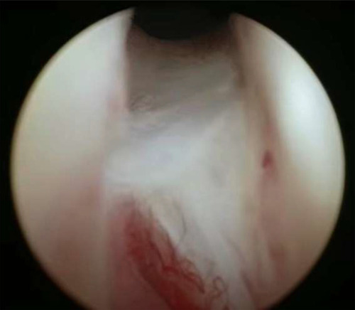 Figure 1 Bladder neck contracture.