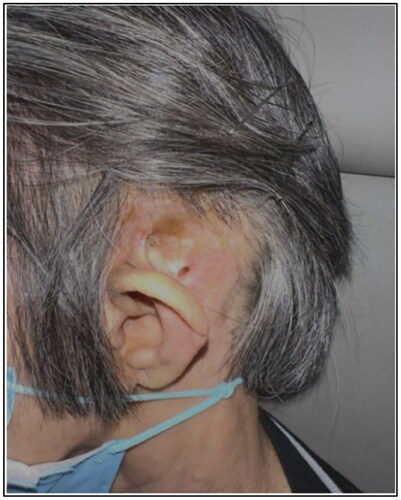 Figure 6. Patient’s mastoid wound one-year after completion of radiotherapy is well epithelialized and no mass is seen.