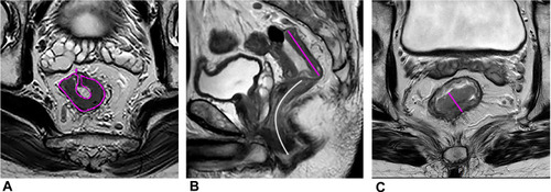 Figure 1 A 55-year-old man with LARC. (A) The maximum tumor area (MTA, pink curved line) on oblique axial HR-T2WI. (B) The maximum tumor length (MTL, pink straight line) and the distance from tumor to anal verge (DTA, white curved line) on sagittal T2WI. (C) The maximum tumor thickness (MTT, pink straight line) on oblique axial HR-T2WI.